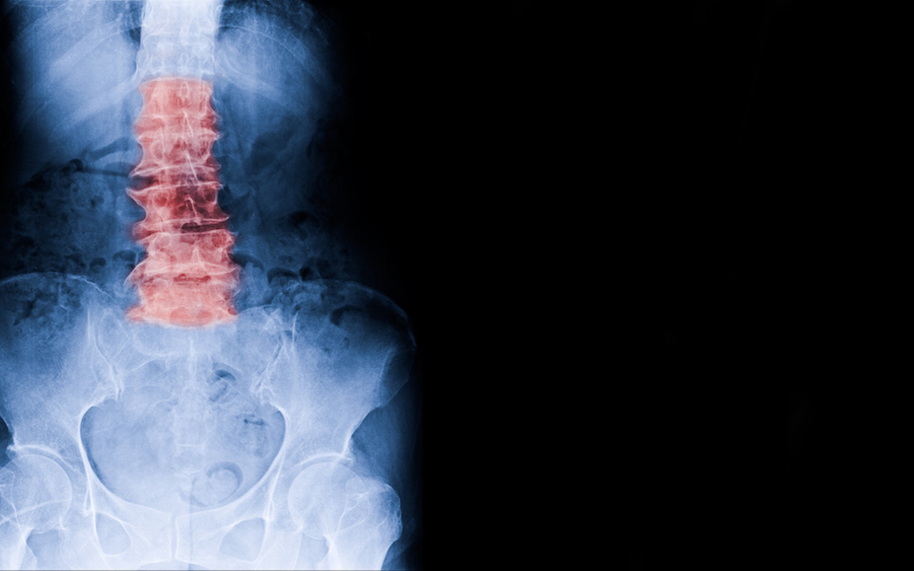 A stock image showing and X-ray of the spine.